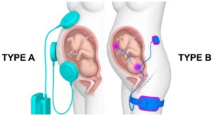 태아 안녕 검사와 자궁 수축 모니터링의 의학적 비교 다이어그램